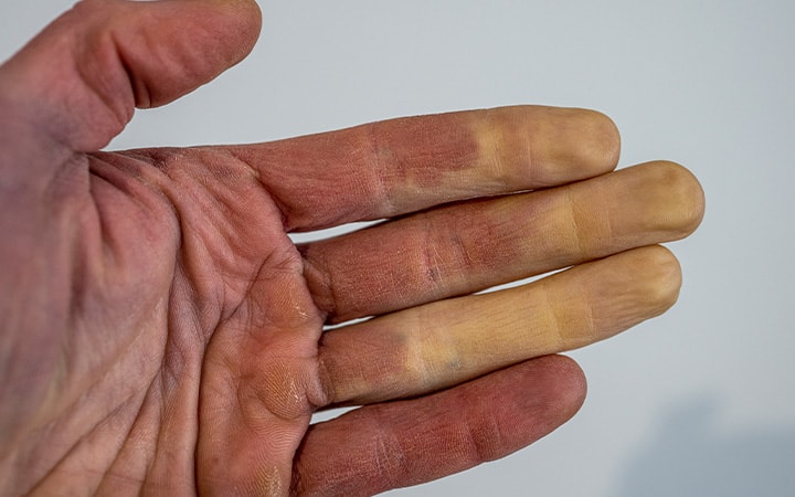 White fingers from Raynaud's syndrome