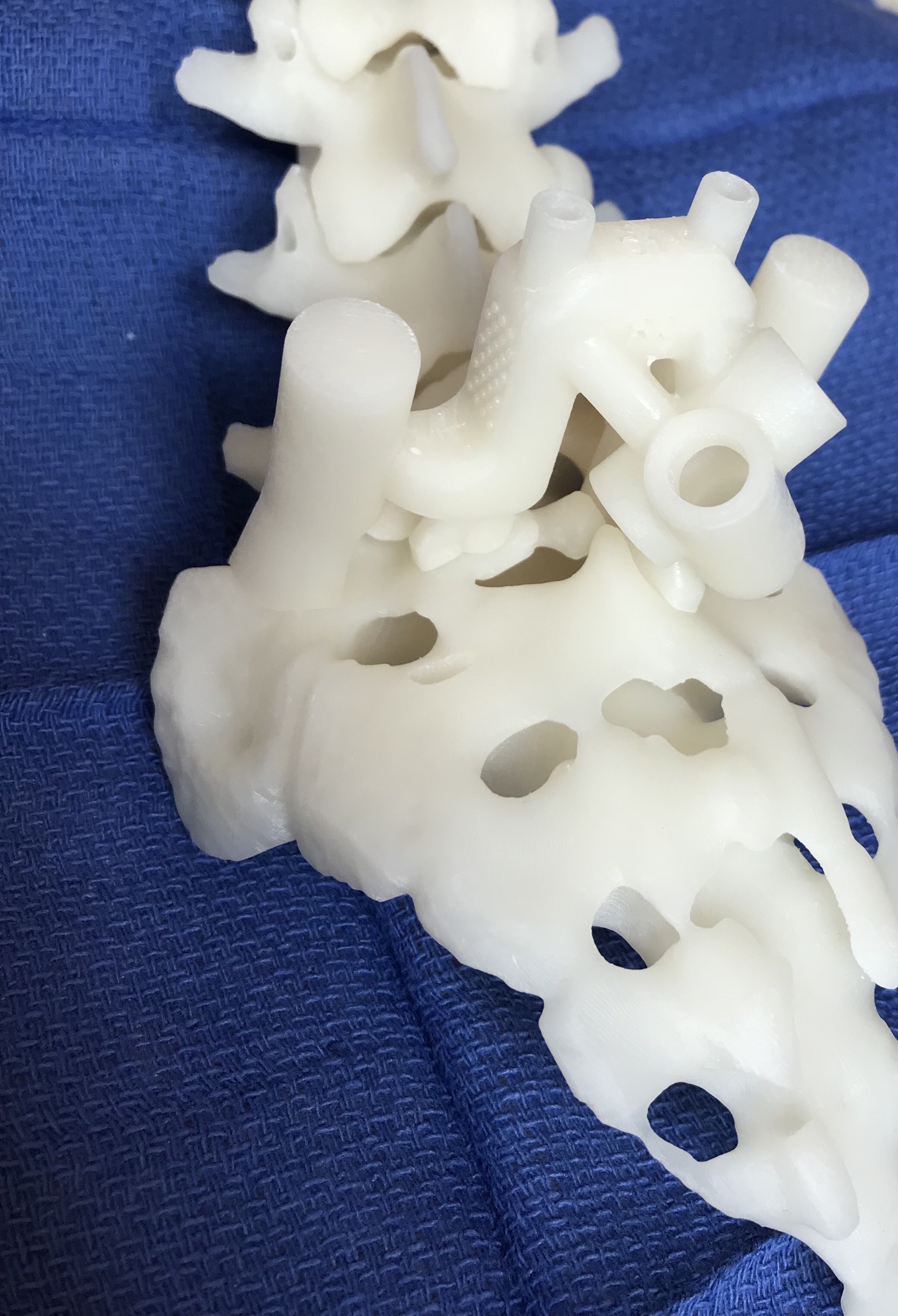 3D printed anatomic model of the patient’s spine with pelvic guide in place