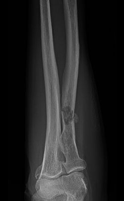 X-ray image showing cancer cells spreading to bone